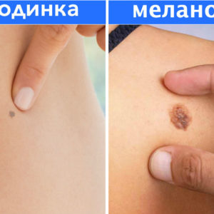 10 мифов о родинках, в которые пора перестать верить