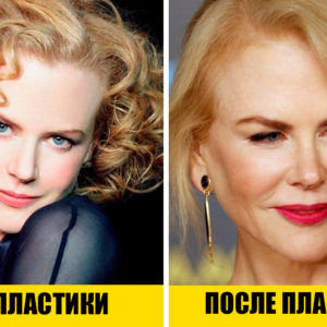 12 звезд, которые сделали пластику и не стесняются этого