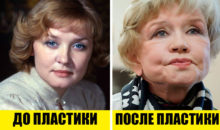 5 красивых и 5 ужасающих результатов пластической хирургии