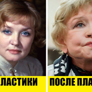 5 красивых и 5 ужасающих результатов пластической хирургии