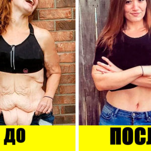 Обвисшая кожа после похудения: почему так происходит, и 8 способов все исправить