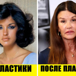 Все на лице написано: 10 неудачных и 10 удачных примеров пластики