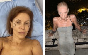 "Разворотили" лицо и тело: 9 звёзд, которым перемены сделали только хуже