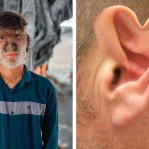 Одни на миллион: 10 людей с причудливыми особенностями тела — природа «постаралась»