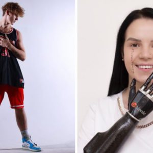 8 звёзд с протезами: нога‑робот, искусственная рука и глаз